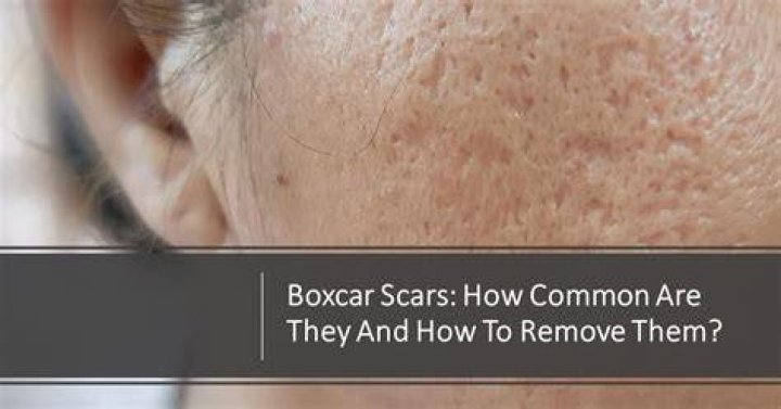 Boxcar scars - How To Discuss