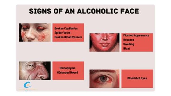 Red face alcohol - How To Discuss